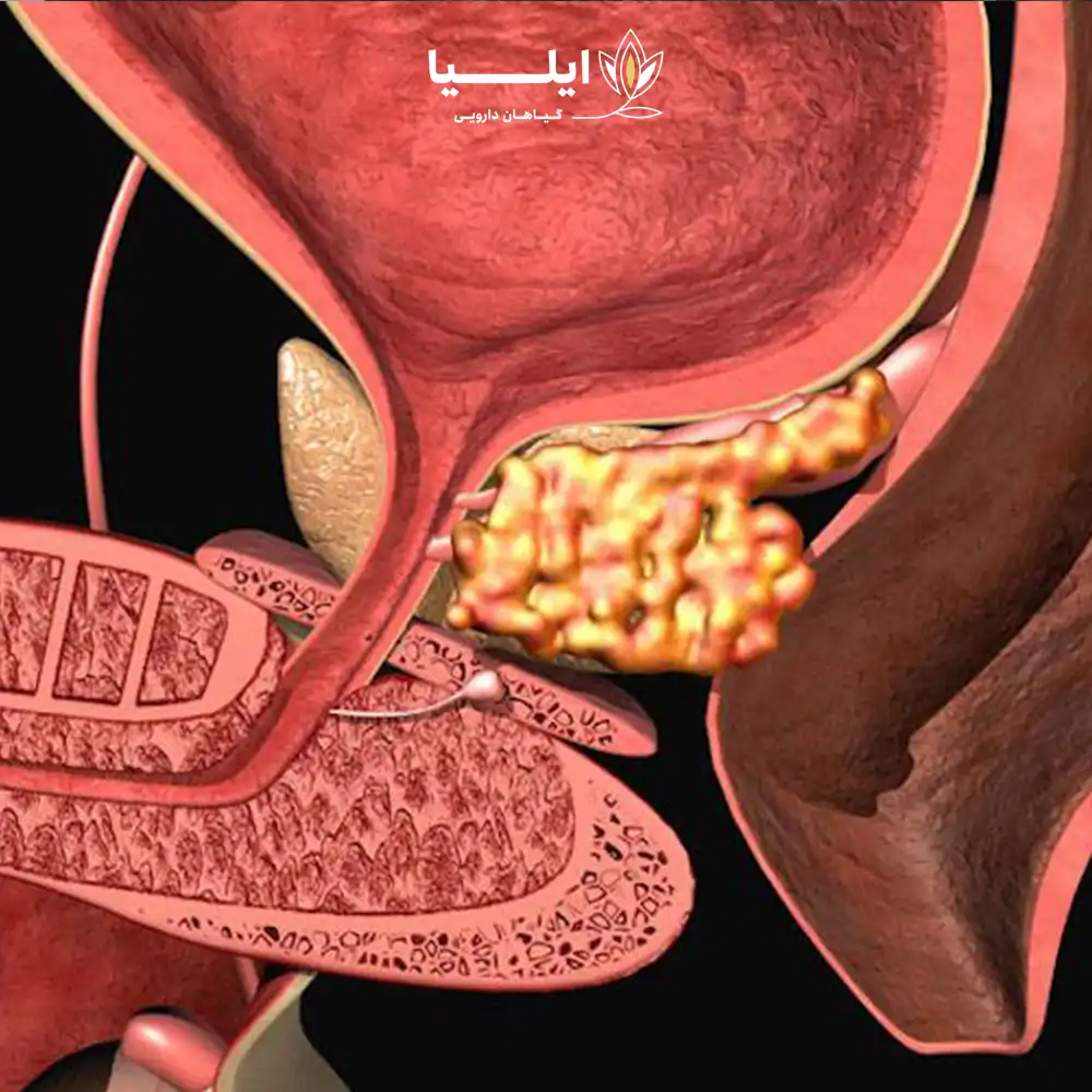 درمان پروستات بزرگ خوش خیم | گیاهان دارویی ایلیا