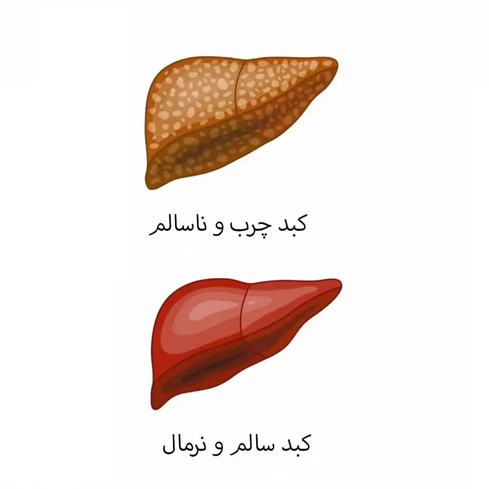 درمان کبد چرب گرید 3- تفاوت کبد چرب سالم و نا سالم